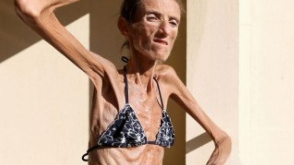 Najchudsza kobieta świata ostrzega przed anoreksją